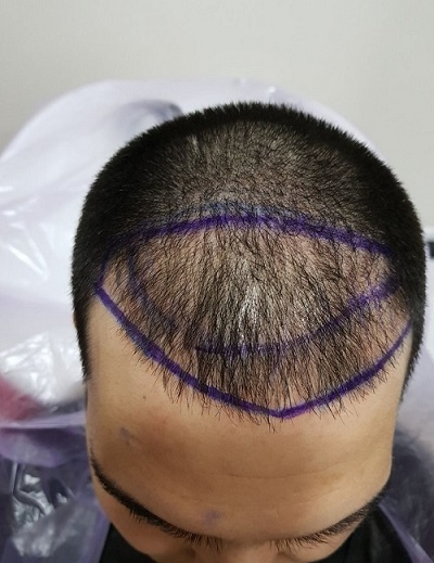زراعة الشعر بدون حلاقة قبل العملية (2).JPG