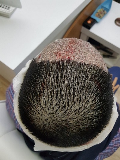 زراعة الشعر بدون حلاقة بعد العملية (2).JPG