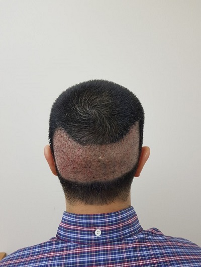 زراعة الشعر بدون حلاقة بعد الغسيل رابع يوم (2).JPG