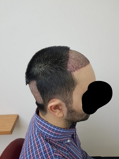زراعة الشعر بدون حلاقة بعد الغسيل رابع يوم (3).jpg