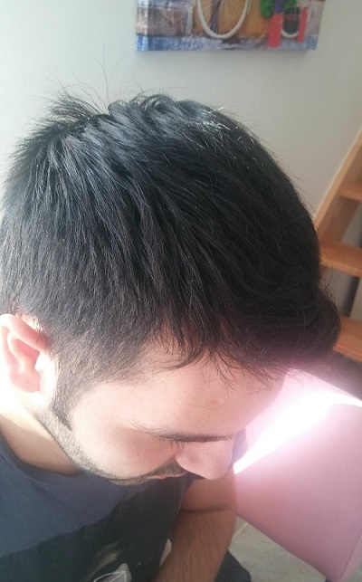زراعة الشعر بدون حلاقة نتيجة بعد 5 شهور (2).JPG