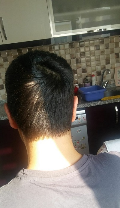 زراعة الشعر بدون حلاقة نتيجة بعد 5 شهور المنطقة المانحة.jpg