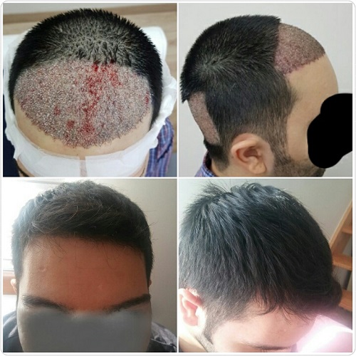 زراعة الشعر بدون حلاقة قبل وبعد.jpg