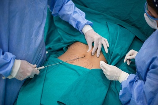 Liposuction .jpg