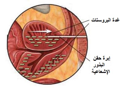 arabshealth- العلاج- بالاشعاع- لعلاج- سرطان- البروستات.jpg