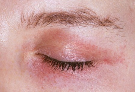 الداء النشواني.jpg