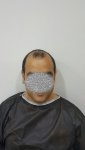 قبل الزراعة- زراعة الشعر في تركيا للرجال 4.jpg