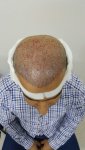 بعد العملية زراعة الشعر في تركيا للرجال.jpg
