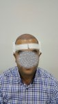 بعد العملية 2 زراعة الشعر في تركيا للرجال.jpg