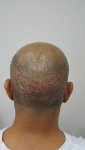 بعد الغسيل ثالث يوم زراعة الشعر في تركيا للرجال 3 .jpg