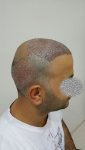 بعد الغسيل ثالث يوم زراعة الشعر في تركيا للرجال 4 .jpg