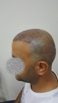 بعد الغسيل ثالث يوم زراعة الشعر في تركيا للرجال 2 .jpg