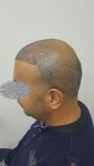خامس يوم بعد الزراعة زراعة الشعر في تركيا للرجال 3.jpg