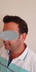 الشهر السابع - جهة يسار- زراعة الشعر في تركيا للرجال.jpg