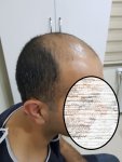 زراعة الشعر في اسطنبول (5).jpg