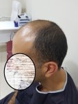زراعة الشعر في اسطنبول (9).jpg