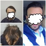 محمد قوتشلو- قبل وبعد 3000 بصيلة.jpg